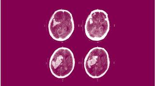 left cerebral hemisphere, causing brain shift to the right side, and causing a tremendous intracranial hypertension